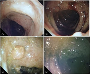 Total colonoscopy finding ulcerated segmental colitis of the left colon and transverse colon, associated with polypoid lesions in the left colon. A) Transverse colon: diffuse erosions with vascular pattern loss and disperse fibrin-covered ulcerations measuring 2 mm. B–D) Left colon: Diffuse erosions with vascular pattern loss, with dispersed 2 mm fibrin-covered ulcerations, can be seen at the most distal part of the left colon. A hyperchromic 11 mm sessile polypoid lesion, with a superficial trabecular pattern and regular vascular pattern, can be seen on chromoendoscopy-narrow band imaging (NBI).