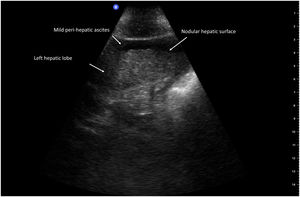 Nodular hepatic surface.