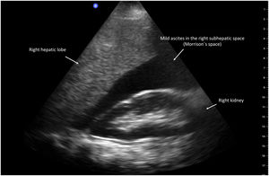 Ascites in Morrison’s space.