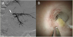 (A) Percutaneous transhepatic cholangiography prior to intraluminal RFA, in which no passage of the contrast agent to the intestinal segment, through the biliary-enteric anastomotic stricture, is observed (arrow). (B) Spyglass™ image of the biliary-enteric anastomotic stricture, with biopsies taken with SpyBite™.