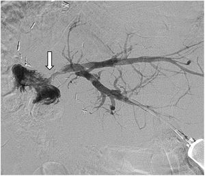 Percutaneous transhepatic cholangiography after treatment with intraluminal RFA, now with adequate contrast agent passage into the intestinal lumen (arrow).
