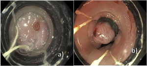 Upper GI endoscopy. A): Visualization of the vessel 32cm from the superior dentate arcade. B): Successful ligation of the visible esophageal vessel.