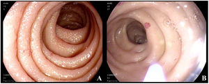(A) Normal mucosa of the second part of the duodenum, with millimetric erythematous lesions. (B) Catheter for applying argon plasma. The normal mucosa is interspersed with millimetric, rounded, pseudovascular, erythematous lesions with spontaneous bleeding from the passage of the endoscope.