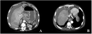 Abdominal CT images with intravenous contrast material in the portal phase, axial MIP reconstruction. (A and B) Signs of chronic liver disease, chronic thrombosis of the suprahepatic veins and inferior vena cava, development of collateral perigastric and perihepatic veins, as well as ascites in all the compartments.