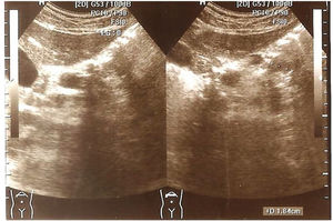 Thirty-one-year-old female. Ultrasound image showing small cysts distributed throughout the pancreas.