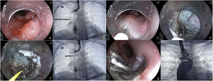 Esophagobronchial fistula closure technique with endoscopic submucosal dissection combined with hemoclips. A) Persistence of the fistula after removal of the OVESCO T clip, 22 cm from the superior dental arch. B) Confirmation of the fistula through contrast medium injection. C) Start of the dissection, with submucosal injection 3 mm proximal to the fistula. D) Complete endoscopic fistulectomy, including dissection at the level of the muscularis propria of the esophagus. E) Passage of the guidewire through the fistula. F) Fluoroscopic image showing the guidewire in the bronchopulmonary region. G) Placement of 3 hemoclips for definitive closure. H) Contrast medium instillation confirming complete closure of the fistula and no signs of contrast medium passage into the bronchial region.