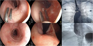 Endoscopic control at 3 months after fistula closure with dissection and hemoclips. A) Image showing the persistence of 2 hemoclips in the dissected region, revealing completely healed tissue around the region. B) Endoscopic contrast medium instillation. C) Fluoroscopic image showing the continued persistence of the 2 clips and absence of contrast medium passage into the pulmonary region. D) Middle and distal esophagus, with no lesions in the mucosa of that region. E) Changes at the level of the gastroesophageal junction after the peroral endoscopic myotomy, with adequate opening of said junction. F) Contrast medium instillation in the distal esophagus showing adequate passage into the gastric cavity and no signs of leaks.
