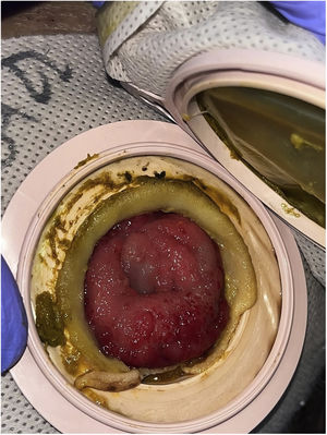 Stoma with peristomal varices and evidence of recent bleeding.