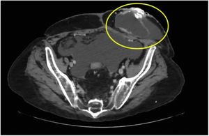 Abdominal computed tomography scan with intravenous contrast medium, showing the cyanoacrylate in the stoma.