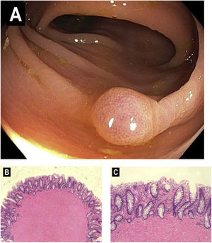 A) A 9mm sessile polyp detected in the transverse colon during colonoscopy. B) Hematoxylin and eosin, 40× magnification. Colonic mucosa containing smooth muscle proliferation suggestive of leiomyoma. C) Hematoxylin and eosin, 200× magnification. The leiomyoma is composed of benign smooth muscle cells with dense pink cytoplasm, arranged in intersecting fascicles. There is no mitotic activity, necrosis, or atypia to suggest a malignant smooth muscle tumor (i.e., leiomyosarcoma).
