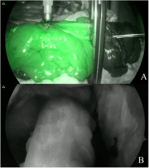Indocyanine green fluorescence angiography at the proximal level (A), with the intracorporeal SPY ENV imaging modality prior to the circular stapler shot (B) with the SPY Contrast imaging modality.