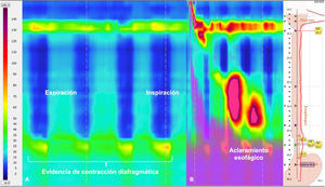 HREM with impedance testing of the asymptomatic patient with type III achalasia that underwent Heller myotomy and Nissen fundoplication. Panel A shows the pressure topogram upon performing the exhalation and inhalation maneuvers to locate the reference points (lower esophageal sphincter/diaphragmatic crura) necessary for ensuring intubation of the esophagogastric junction. They were successfully identified in this patient. Panel B shows the esophageal clearance.