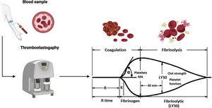 Thromboelastography parameters.58 Thromboelastography (TEG) provides us with several parameters: • R time. Defined as the time from the start of the TEG tracing until the trace reaches an amplitude of 2 mm (normal: 5–10 min), representing the initial clot formation rate (initiation phase) that is primarily related to the activity of the procoagulant and anticoagulant coagulation factors. Its prolongation is the result of deficiencies in the coagulation factors or severe hypofibrinogenemia. • K time. Defined as the time from the end of the “R time” until the trace reaches an amplitude of 20 mm (normal: 1–3 min), representing dynamic clot formation (amplification phase) that is related to the activity of clotting factors, fibrinogen, and platelets. • α. The angle formed by the slope of a tangent line, traced from the initiation of clotting (normal range: 53° to 72°); it measures the rate at which fibrin crosslinking occurs (thrombin propagation phase) and the function of platelets and plasma factors on the surface of the platelets. • MA. Maximum amplitude of the TEG trace (normal: 50–70 mm), reflecting the maximum clot strength (general stability of the clot) and directly showing the interaction of platelet function and plasma coagulation factors. • LY30. The percentage of the decrease in trace amplitude 30 minutes after the MA (normal 0–8%), reflecting initial clot dissolution (fibrinolysis). Figure created using Biorender.com with data modified from Turco et al.59