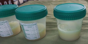 Milky-appearing ascitic fluid.