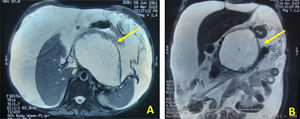 A–B: Capsular hyperintense image, with partial septa in the body and tail of the pancreas, associated with abundant free fluid.