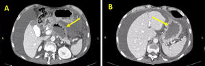 Multi-slice spiral computed tomography of the abdomen, with contrast. A) Pancreatic collection showing less volume than in previous images. B) Gastric chamber with adequate distension.
