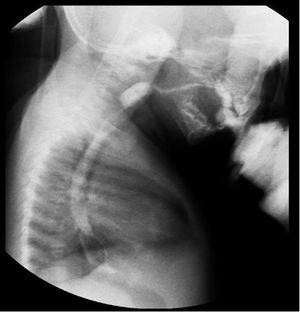 Esophagogastroduodenoscopy: 60% reduction of the cervical lumen between C3 and C4, filiform passage of the contrast agent into the gastric cavity, accumulation of the contrast agent in the pharynx, with velopalatine and oronasal reflux.