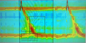 High-resolution esophageal manometry: abnormal pressurization pattern in the cricopharyngeus muscle caused by increased intrabolus pressure, with medium pressure of the esophageal sphincter: 140 mmHg (normal: 34-104 mmHg).