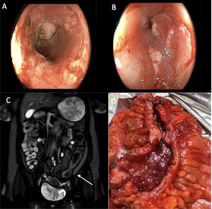 A-B) Endoscopic study performed prior to surgery, showing erythematous and friable mucosa with multiple ulcers and an uncrossable stricture in the sigmoid colon. C) MRE showing a strictured area at the same site (white arrow). D) Surgical specimen after resection, showing a strictured area, with mucosal involvement and transmural extension.