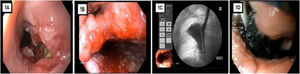 Endoscopic views. A) Ulcerated and partially strictured lesion in the middle third of the esophagus, occupying 75% of the circumference. B) Anastomotic dehiscence of two-thirds of the esophageal circumference. C) Contrast medium leakage into the pleural cavity evaluated through fluoroscopy. D) Vacuum therapy in the cavity with the Eso-Sponge®-B Braun system.