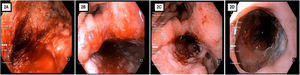 Images A, B, C, and D sequentially correspond to the endoscopic findings during the sponge replacement sessions. They show the progressive healing of the defect, ending in the recovery of the affected area.