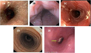 Endoscopic images of the esophagus in patients with EoE. Inflammatory phenotype: A) edema of the mucosa and whitish exudates on the circumference of the esophagus. B) Transverse and longitudinal furrows in the mucosa, or “feline esophagus”. C) mucosal sloughing, “crêpe paper mucosa”. Fibrostenotic phenotype: D) severe grade circumferential rings. E) Stricture of the esophageal lumen with food impaction (arrow).