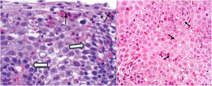 Biopsy of the esophageal mucosa with eosinophilic esophagitis. There is eosinophilic infiltration above 15 eosinophils per high power field (thin arrows) and hyperplasia of the basal layer of the squamous epithelium (thick arrows).