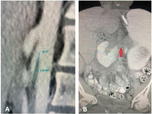A) Sagittal view of the abdominal tomography scan with intravenous contrast shows decreased angle and distance between the superior mesenteric artery and the aorta (10° and 3.1 mm). B) Coronal view of the abdominal tomography scan with oral contrast shows the compression at the level of emergence of the superior mesenteric artery and the aorta, with retrograde gastroduodenal dilatation (arrow).