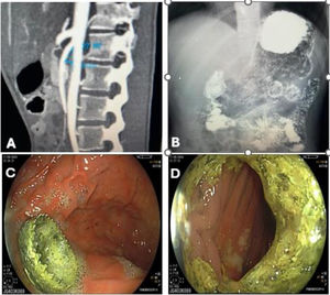 A) Coronal view of the abdominal tomography scan with intravenous contrast 12 months later, with improvement in the angle and distance between the superior mesenteric artery and aorta (27° and 8 mm). B) Gastrointestinal series 6 months after EUS-GJA, with advancement of the gastroduodenal and gastrojejunal media. C) Endoscopic image of the proximal end of the LAMS 18 months later. D) Endoscopic image of the distal end of the LAMS 18 months later. EUS-GJA: endoscopic ultrasound-guided gastrojejunal anastomosis; LAMS: lumen-apposing metal stent.