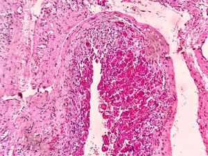 Medium magnification photomicrography (H&E staining) showing the increase in endothelial cells in small-caliber vessels.