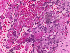 High magnification photomicrography (H&E staining) showing intravascular papillary endothelial hyperplasia.