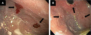 A) Bleeding ulcer in the gastric body. B) Ulcers in the gastric fundus.