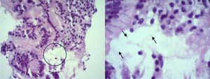 Helicobacter pylori in glycocalyx.