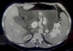 Dilation of the celiac trunk and splenic artery (black arrows), with early opacification of the splenic vein (white arrows) and the portal vein (asterisk), secondary to the splenic arteriovenous fistula.