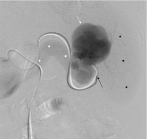 The splenic artery is selectively cannulated (black arrow), and DSA is conducted from the distal portion of the artery, identifying the arteriovenous fistula with a venous aneurysm (white arrow) and revealing immediate opacification of the splenic vein (white asterisks) without any blush of the splenic parenchymal (black asterisks).