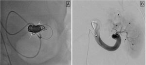 A) Superselective catheterization is performed using a microcatheter, followed by embolization with microcoils (indicated by white arrows) until the fistula is occluded. B) Control angiography from the proximal portion of the splenic artery, showing no opacification of the previously described venous aneurysm; the coils are visible (white arrows), along with the parenchymal branches (black arrows), and adequate splenic parenchymal blush (black asterisks).
