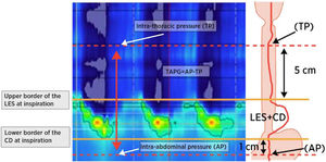 Thoracoabdominal pressure gradient (TAPG) measurement methodology. CD: crural diaphragm; E: expiration; I: inspiration; AP: intra-abdominal pressure; TP: intrathoracic pressure; LES: lower esophageal sphincter.