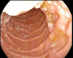 Whitish micronodular lesions in the gastroscopy, upon reaching the second part of the duodenum.