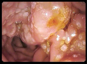 Duodenoscopy, showing multiple whitish micronodules surrounding the major duodenal papilla.