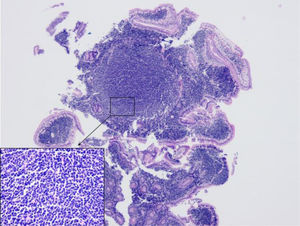 Biopsy from the duodenum, with a uniform lymphocytic infiltrate forming follicular aggregates, with no visualization of macrophages (hematoxylin and eosin [H&E] staining, ×40, in the lower left corner of the image).