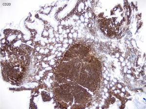 Immunohistochemistry with positive CD20 staining of a duodenal biopsy sample, confirming the B-lymphocyte cell line.