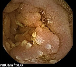 Capsule endoscopy, revealing patchy micronodules reaching the most distal parts of the duodenum.