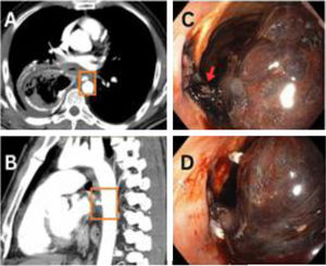 (A) Axial and (B) sagittal views of the initial CT scan, showing fistulous communications between the aorta and gastric conduit. (C) Endoscopic image showing a hematoma (red arrow) and some active bleeding from the fistula site. (D) Endoscopic image showing the attempted endoscopic clipping (white clips).
