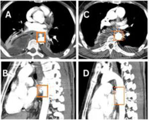 (A) Axial and (B) sagittal views of the CT aortogram after the first stent placement in the aorta, showing partial covering of the fistulous communication. (C) Axial and (D) sagittal views of the CT aortogram after the second stent placement in the aorta, showing complete covering of the fistulous communication.
