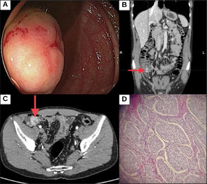 (A) Colonoscopy showing a 3 cm lesion in the cecum. (B and C) Coronal and axial views of contrast-enhanced CAT scans, showing a lesion at the medial and inferior edge of the cecum, characterized by an 18 mm focal thickening of the wall, with endoluminal extension. (D) Histopathologic section of a grade 2, well differentiated neuroendocrine tumor, showing an epithelial tumor with nest-shaped growth, cells with moderately pleomorphic nuclei, and lax or dense chromatin, as well as mitosis and scant cytoplasm. The tumor is developed in a vascularized stroma and shows infiltration through all the layers of the colon, extending beyond the serosa. Source: Clinical history of the patient.