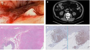 (A) shows the endoscopic image of an impassable stricture with adenomatous edges and friable when touched by the endoscope. (B) CT image showing a mass in the transverse colon that narrows the intestinal lumen, without retrograde dilation. (C and D) Anatomopathologic study confirming the presence of a colonic leiomyosarcoma, positive for actin and desmin, and negative for GIST markers, such as CD117.