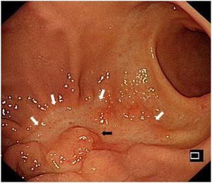 Endoscopic views seen during the gastroscopy examinations. The black arrow indicates the 0-IIa (slightly elevated area) and the white arrows indicate the 0-IIc (slightly depressed area).