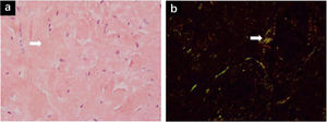 a) Gastric tissue biopsy stained with Congo red, indicating amyloid deposition. b) Gastric tissue biopsy under polarized light microscopy, displaying apple-green birefringence. Areas of positive reaction are indicated by the white arrows.