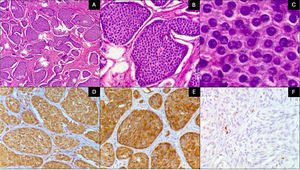 Histologic characteristics of 2 grade 1 neuroendocrine tumors. A) The tumor is arranged in a nest pattern (H&E ×10). B) Monotonous cells with no mitosis (H&E ×40). C) Nuclei show coarse granular chromatin and a moderate quantity of eosinophilic cytoplasm (H&E ×100). D) Chromogranin positivity. E) Synaptophysin positivity. F) Ki-67 quantified at 2%.