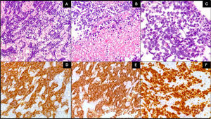 Histopathologic characteristics of a neuroendocrine carcinoma. A) The tumor presents an infiltrating pattern (H&E ×10). B) The presence of tumor necrosis (H&E ×20). C) Pleomorphic cells with hyperchromatic nuclei, scant cytoplasm (H&E ×40). D) Chromogranin positivity. E) Synaptophysin positivity. F) Ki-67 quantified at 90%.